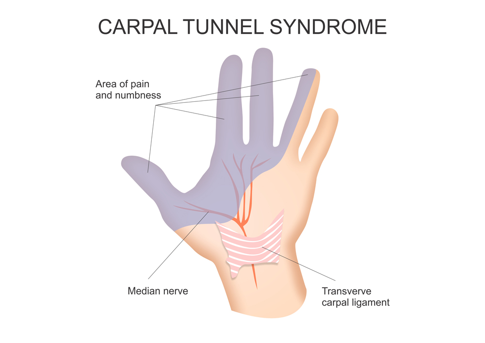 Picture demonstrating nerves in hand and carpal tunnel syndrome