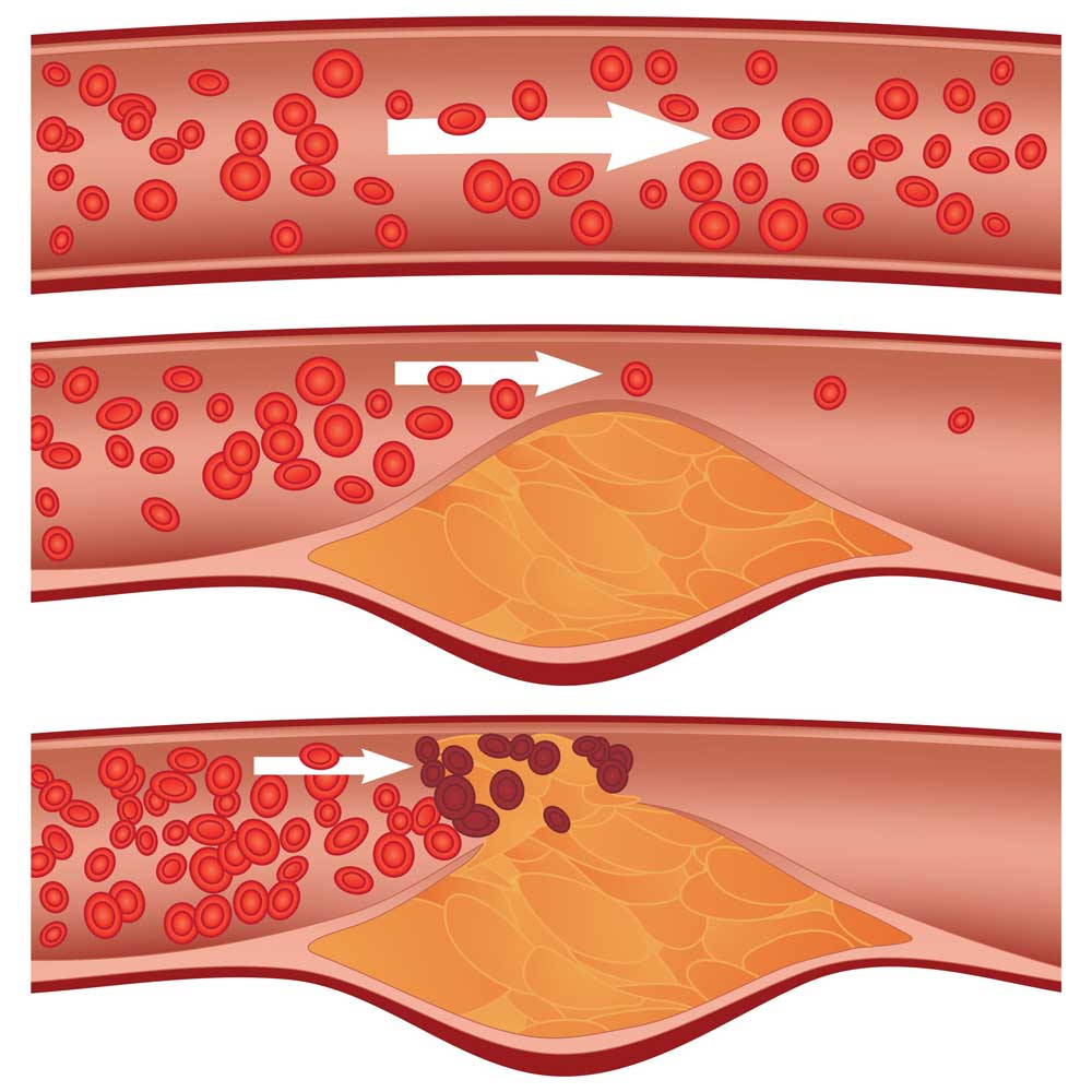 Cholesterol plaque causing a clogged artery